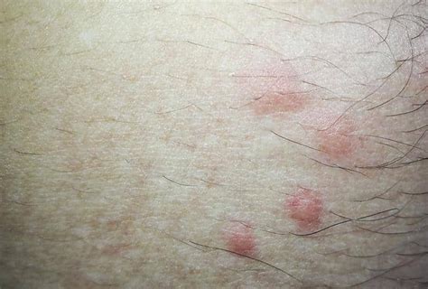 Don't worry though, if there are no apparent signs other than itching, they usually disappear by themselves. Flea Bites : Flea Bites Appearance Symptoms And Treatments ...