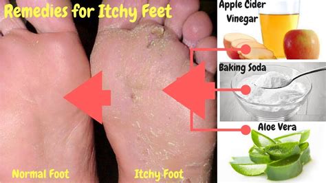 Foot Itching Remedies Foot Care Tips