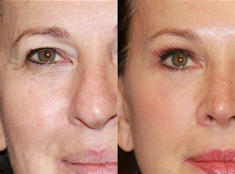 Eyelid Surgery Upper And Lower Blepharoplasty Surgery Recovery