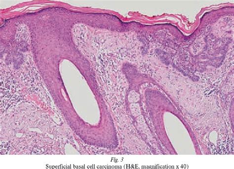 Figure 3 From Histological Types Of Basal Cell Carcinoma Semantic Scholar