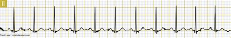 Sinus Tachycardia ECG EKG Rhythm Nursing Review