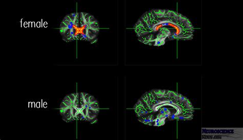 Effects Of Obesity On The Brain Sex Related Differences In The Brain’s White Matter