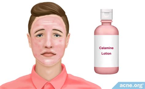 Does Calamine Lotion Clear Acne
