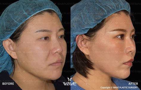 Flash Lift Facelifts In Los Angeles Wave