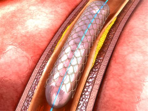 Stents Dont Prevent Future Heart Attakcs Easy Health Options
