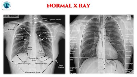 Chest Xray Normal Vs Abnormal Startlynx