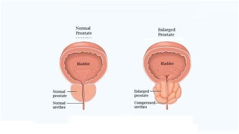The Prostate Gland A Comprehensive Guide Helal Medical