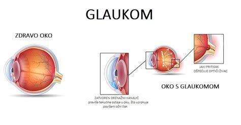 Šta je glaukom i da li se može pojaviti u ranim 20 tim