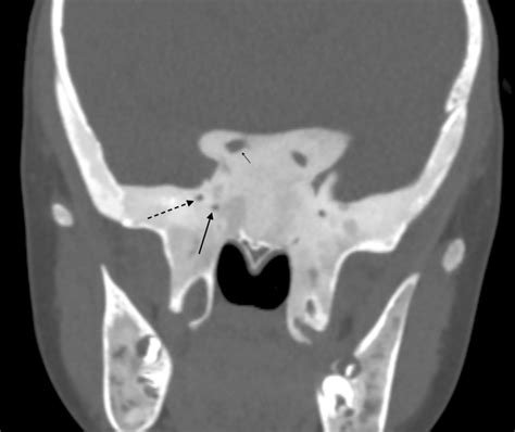 Coronal Ct Image In The Same Child As Figure 2 Both Foramen Rotundum