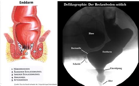 Primär geht es darum, den after kontinuierlich anzuspannen und wieder zu entspannen. proctology.de | End und Dickdarmzentrum | Duisburg ...