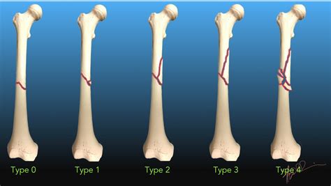 Winquist And Hansen Classification Of Femoral Fractures Uw Emergency Radiology