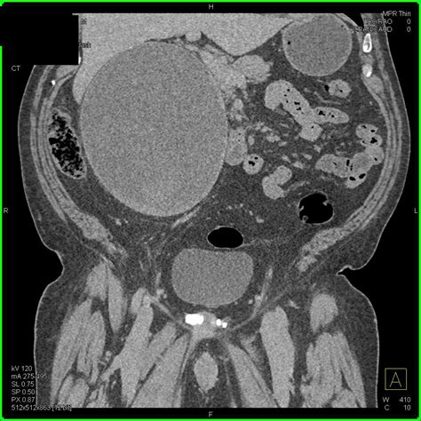 Complex Right Renal Cyst Kidney Case Studies Ctisus Ct Scanning