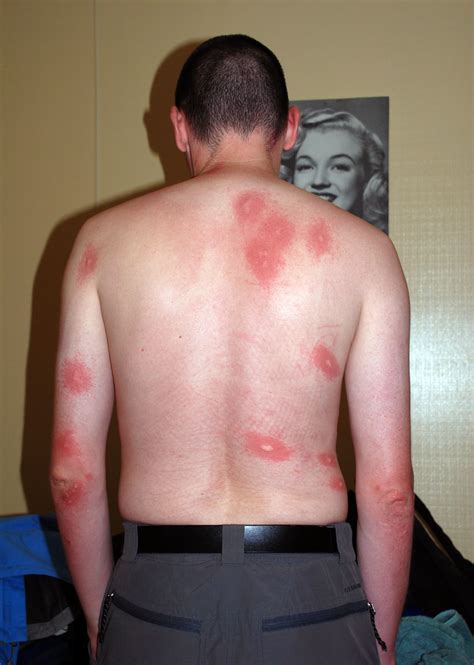 Check spelling or type a new query. Mosquito bites | Despite having repellent on and wearing a ...