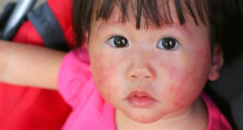 4 Useful Tips To Treatment Of Atopic Dermatitis In Children