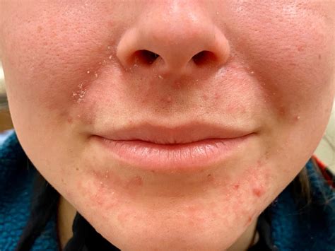 Papules Acne On Chin