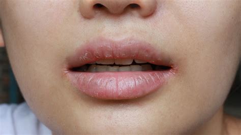 7 Ways To Remedy Those Uncomfortable Cracked Lip Corners