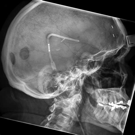 Radiography Of Skull Devices Wikiradiography