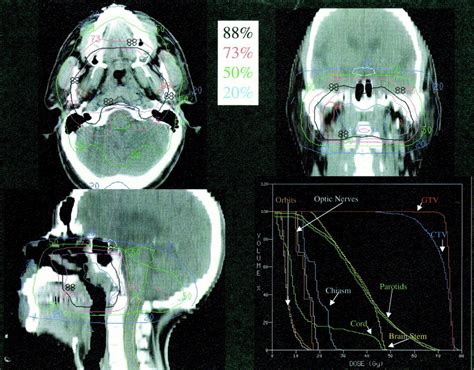 Intensity Modulated Radiotherapy In The Treatment Of Nasopharyngeal