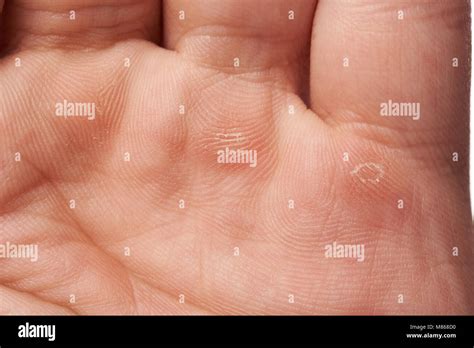 Blister On Palm Of Hand Hi Res Stock Photography And Images Alamy