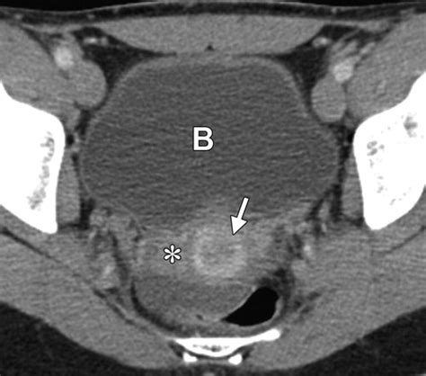 Normal Or Abnormal Demystifying Uterine And Cervical Contrast