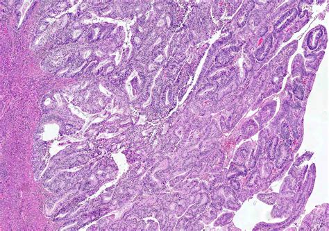 Pathology Outlines Endometrioid Carcinoma