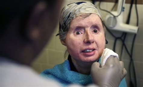 Treatment Of Charla Nash Mauled By Chimpanzee Could Help Disfigured Soldiers Daily Mail Online
