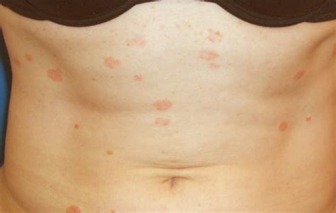 Pityriasis Rosea Pictures