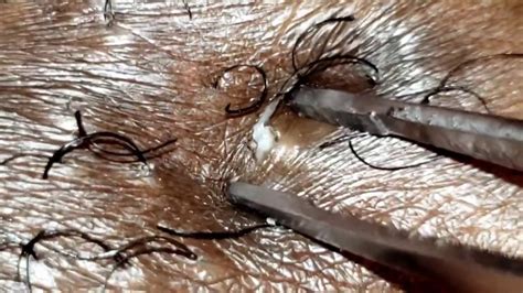 Tight, curly hair is the main risk factor for ingrown hairs, according to the mayo clinic. INGROWN HAIR REMOVAL #11 - YouTube
