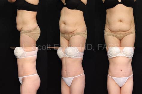 How Long Do You Wear Drains After Tummy Tuck Best Drain Photos