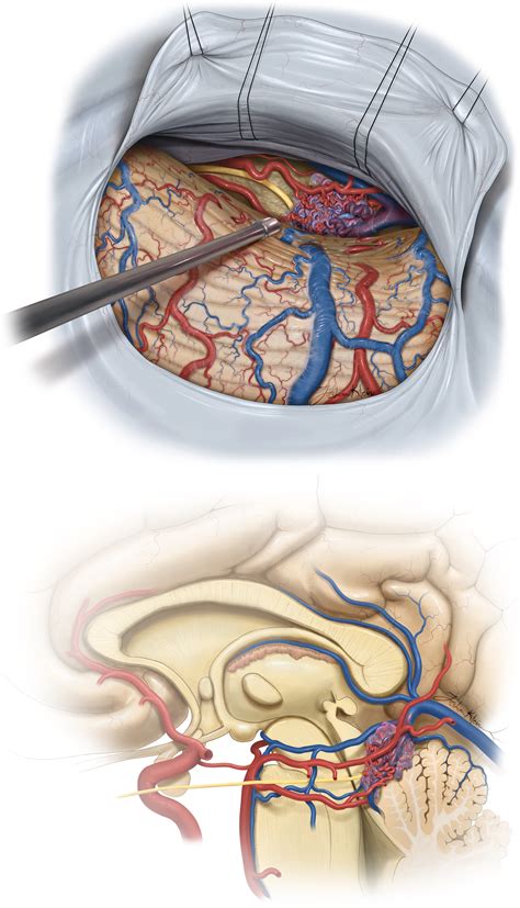 Brainstem Avms The Neurosurgical Atlas By Aaron Cohen Gadol Md