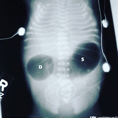 Medical Photo Vibes Medicalranger Instagramissa ”double Bubble Sign Seen In Duodenal Atresia