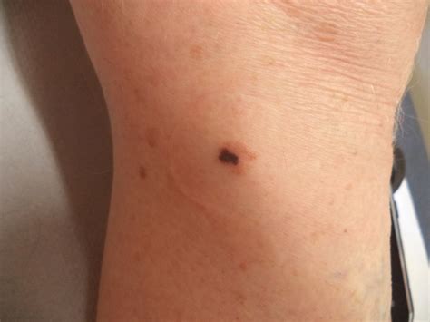 Dermoscopy Melanoma Skin Cancer Can Be Fatal Unless Caught Early But