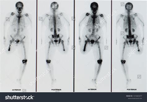 Bone Scan Scintigraphy Image Showing Patient Stock Photo Edit Now