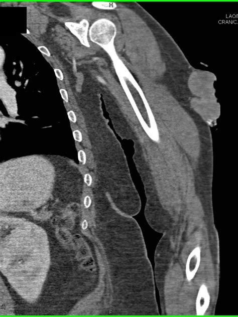 Soft Tissue Sarcoma Left Arm Musculoskeletal Case Studies Ctisus Ct