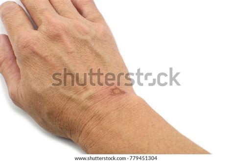 Womans Hand Wounds Scratch On Skin Stock Photo 779451304 Shutterstock