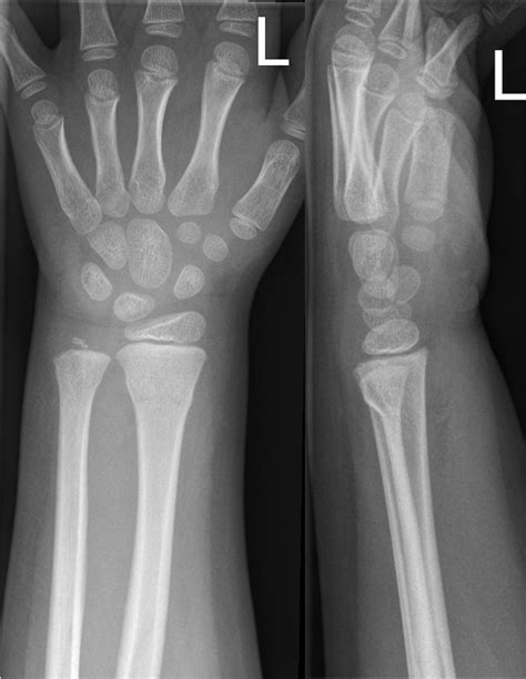 Fractures Distal Forearm Or Wrist