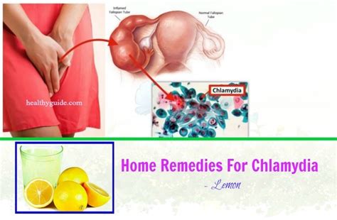 25 Fast Home Remedies For Chlamydia Infection And Itching In Males And Females
