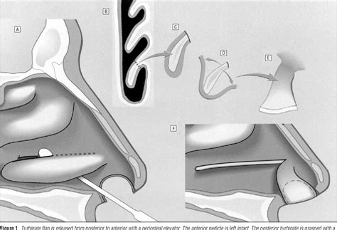 Figure 2 From Nasal Reconstruction Using The Inferior Turbinate Mucosal