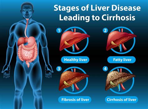 Stages Of Liver Disease Leading To Cirrhosis Vector Art At Vecteezy