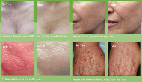 Oasis Skin Institute Lumecca Skin Rejuvenation