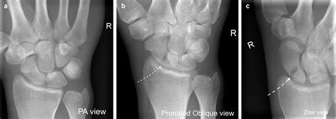 Fractures Of The Scaphoid The Bmj