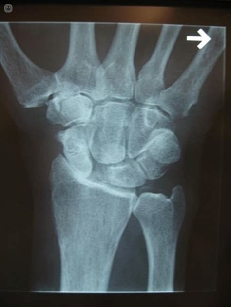How Did I Develop Arthritis In My Wrist Top Doctors