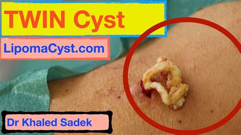 Twin Cyst Removal Dr Khaled Sadek Youtube