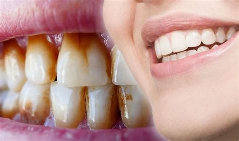 Remove Coffee Stains From Between Teeth Tips To Help Avoid Stained