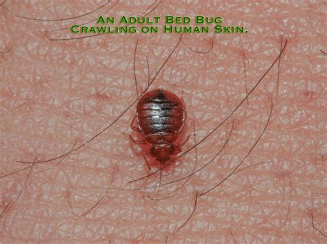 Severe Reaction To Bed Bug Bites Mississauga Pest Control