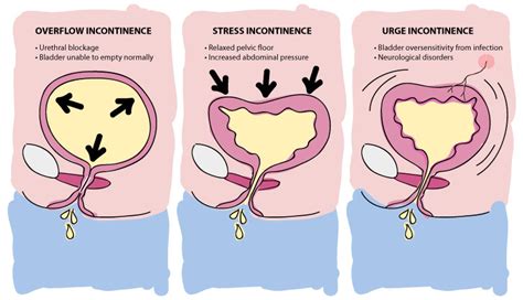 Types Of Incontinence Panacea Mk