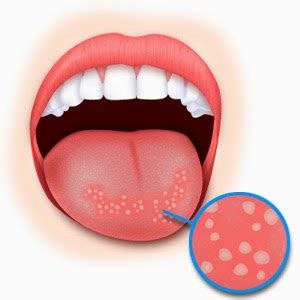 Sariawan, apalagi yang muncul di lidah, merupakan suatu masalah yang cukup mengganggu. Cara Mengobati Sariawan Di Lidah ~ Obat Herbal Gondok Beracun