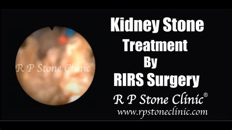 Kidney Stone Treatment By Flexible Ureteroscopy Rirs Surgery Youtube