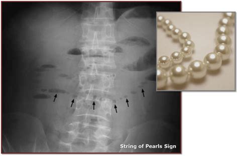 Check spelling or type a new query. String of Pearls Sign (X-Ray) - radRounds Radiology Network