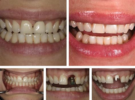 Single Tooth Implants Nyc Dental Implants Manhattan Ny